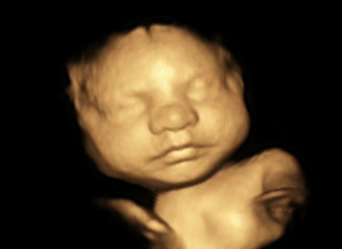 Échographie 3D · profil
